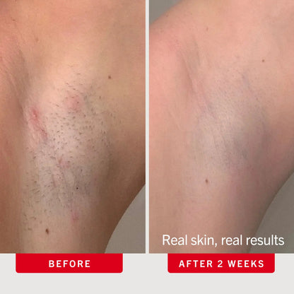 Ingrown Bump-Smoothing Duo